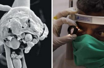 Black Fungus Without Testing Positive